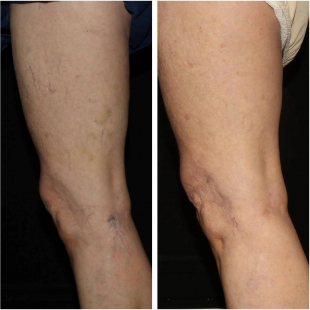 Sclerotherapy - Case #2 